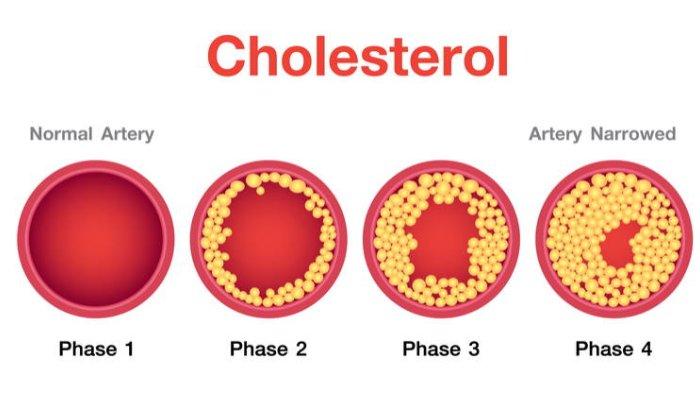 Penyakit Kolesterol